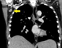 Axillary lymphadenopathy