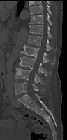 Osteoblastic lesions of multiple myeloma