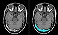 Thrombose (im rechten Bild blau hervorgehoben) in den Sinus transversi im axialen T1w-Schnittbild einer MRT.