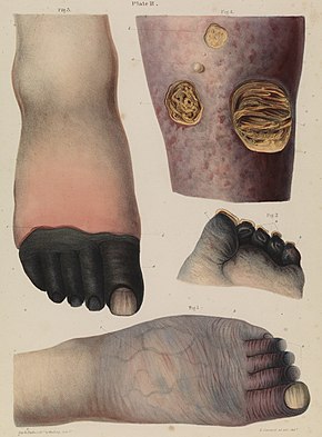 Four drawn illustrations on a page, including (top left) a foot with black toes, (top right) a limb with holes in the skin showing yellowed matter beneath, (centre right) the end of a foot with blackened stubs where the toes once were, and (bottom) a foot that is wrinkled and dark, with prominent veins and purple toes.