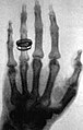 Roentgen's X-ray picture of the hand of Alfred von Koelliker