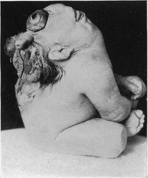 File:Cyclopia side.jpg