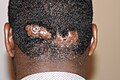 Scalp keloid in occipital area