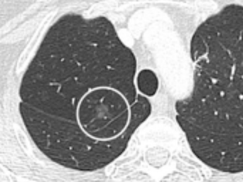 Ground glass opacity nodule.[9]