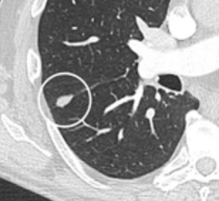 A triangular perifissural node can be diagnosed as a benign lymph node.[9]