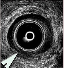 anal lateral sphincterotomy