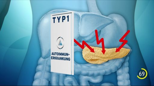 SCHLAUES in 100 Sekunden: Diabetes