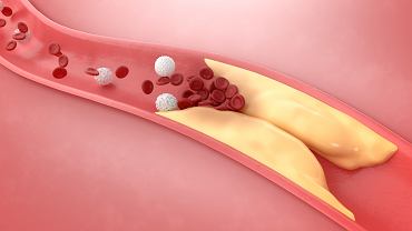 Jak obniy poziom 'zego' cholesterolu? Kluczowe s te trzy zasady