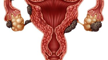 Torbiel czekoladowa (endometrialna): objawy, leczenie